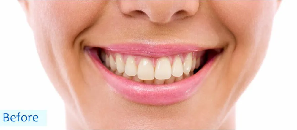 Teeth whitening before treatment