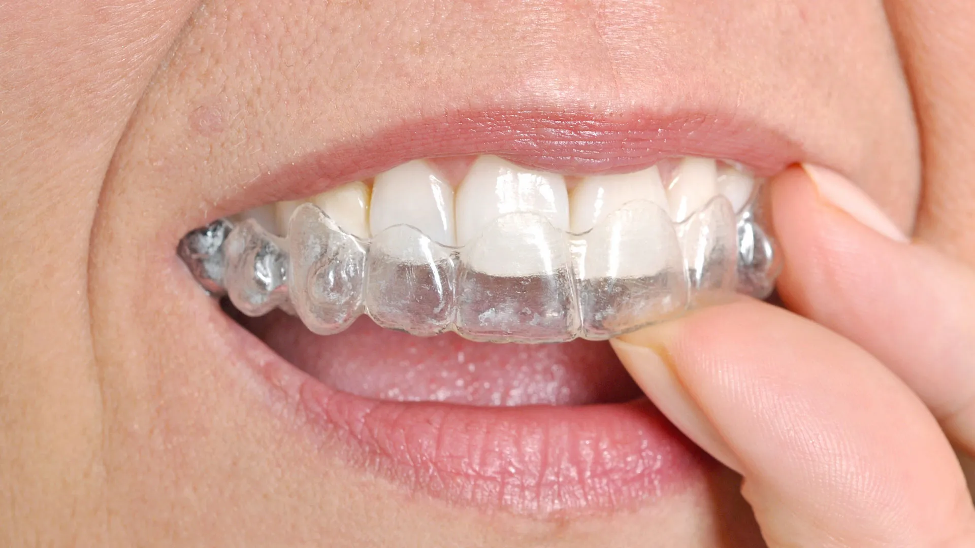 Tooth-Coloured Fillings
