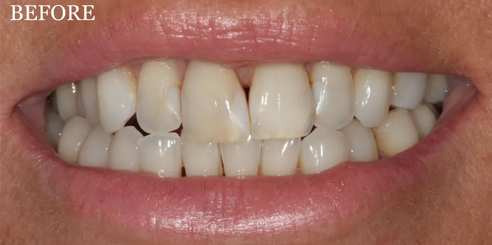 Porcelain veneers before treatment