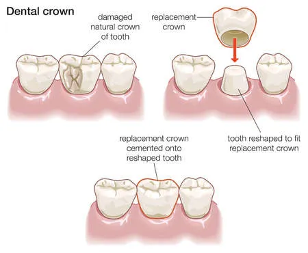 Porcelain crown treatment diagram