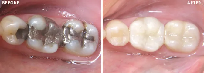 Tooth-Coloured Fillings
