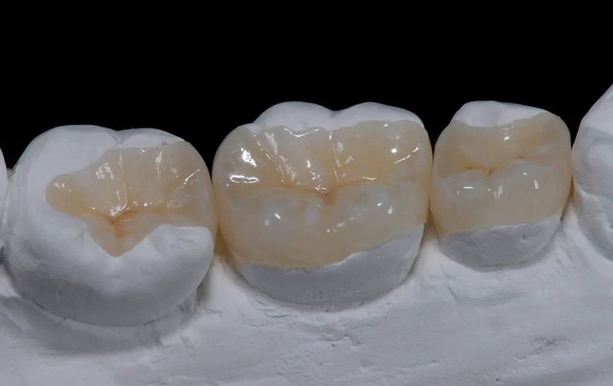 Tooth-Coloured Fillings