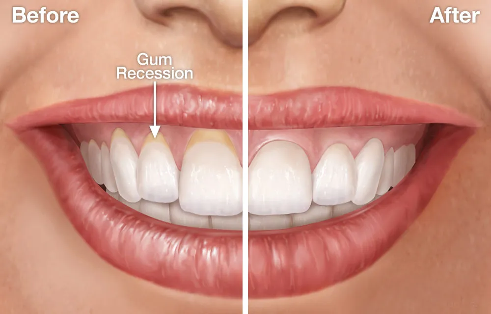 Tooth-Coloured Fillings