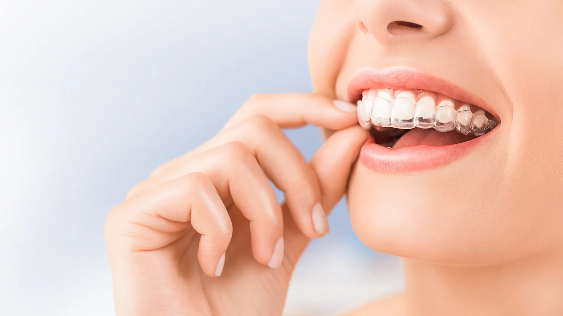 Tooth-Coloured Fillings
