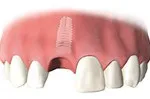 Dental implant covered with a protective cap during healing
