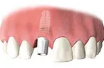 Dental implant abutment attached after healing
