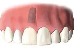 Porcelain crown fitted to the dental implant