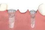 Dental implant covered with a protective cap during healing