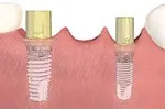 Dental implant abutment attached after healing