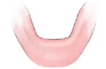 Denture before implant support