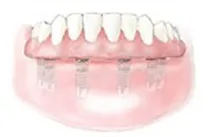 Completed implant-supported denture