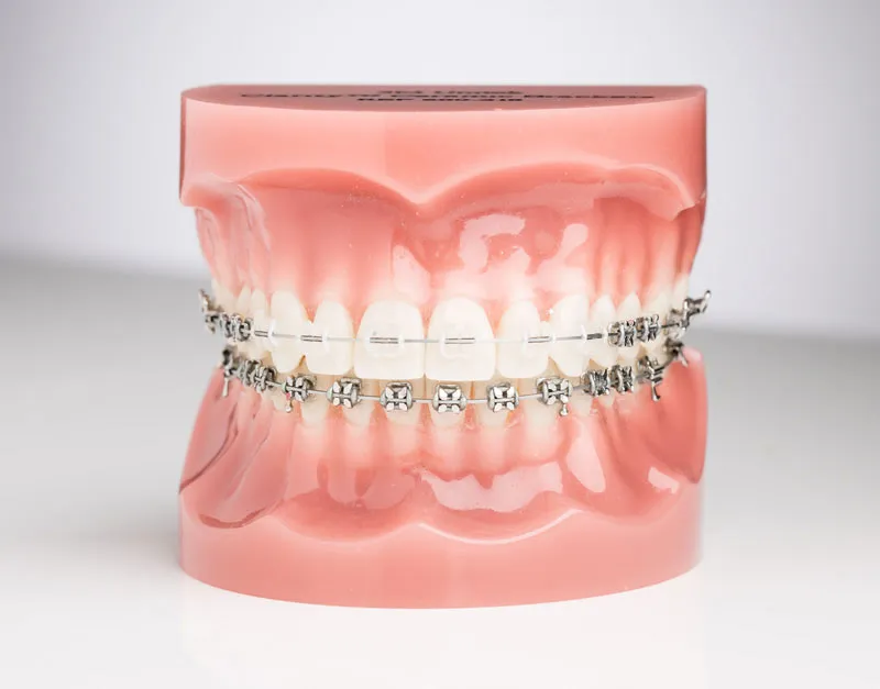 Traditional metal braces model