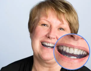 Oral appliance for sleep apnea
