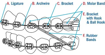 Diagram showing parts of traditional orthodontic braces