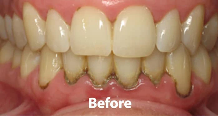 Gum condition before periodontal treatment